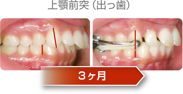 下顎前突（受け口）